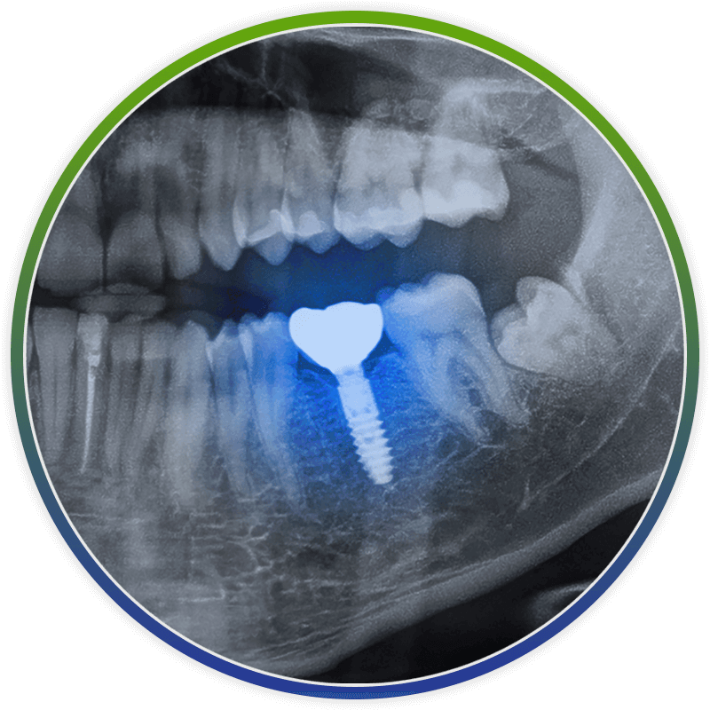 close up of dental implant xray