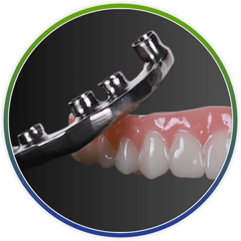 titanium frame next to full arch dental implants