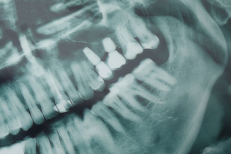 An infographic comparing the lifespan of well-maintained dental implants versus poorly maintained ones, visually representing factors like regular check-ups, proper oral hygiene, and lifestyle choices. No text on image.
