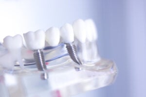 Patient consultation in modern dental office discussing full mouth implants